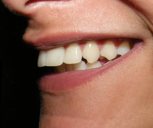 dentes2