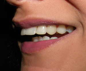 dentes3