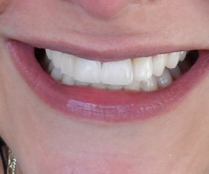 dentes5